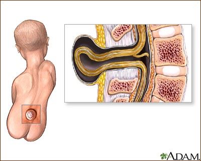 Neural Tube Defects